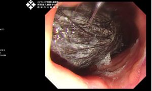 endoscopy image showing trichobezoar hairball inside child stomach