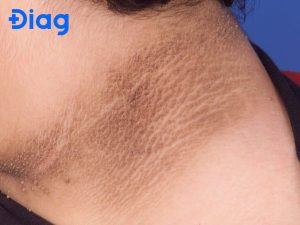 Acanthosis nigricans on the neck as an early sign of diabetes and insulin resistance