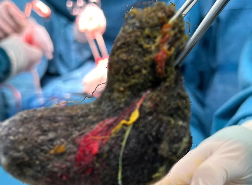 Hairball Fills 7-Year-Old Girl’s Stomach: A Hidden Danger Parents Must Not Ignore