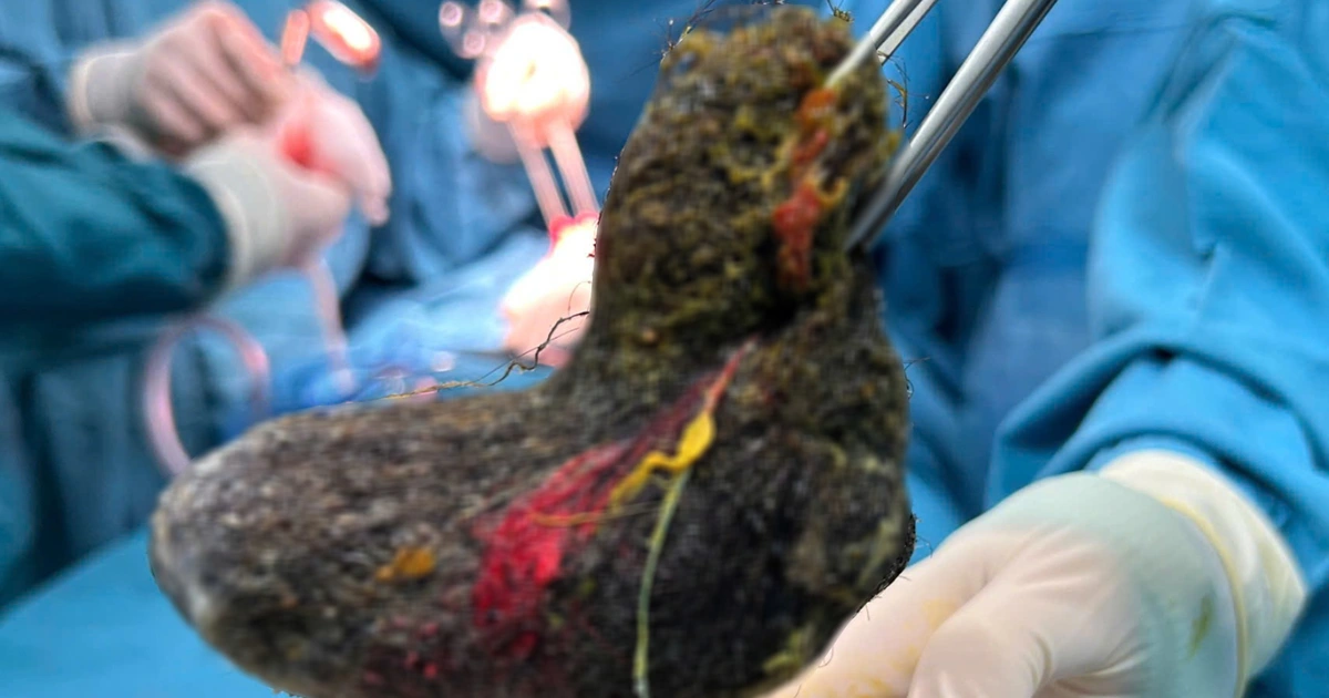 Hairball Fills 7-Year-Old Girl’s Stomach: A Hidden Danger Parents Must Not Ignore